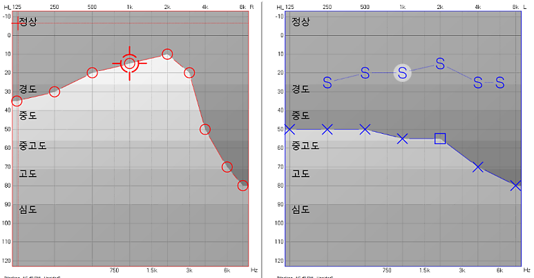 포낙 오데오 인피니오 스피어 대학병원에서 구매하신 60대 여성 고객님 착용 후기