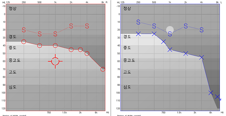 포낙 오데오 인피니오 R 후기, 처음 보청기도 편안하게 적응한 70대 어머님 사례