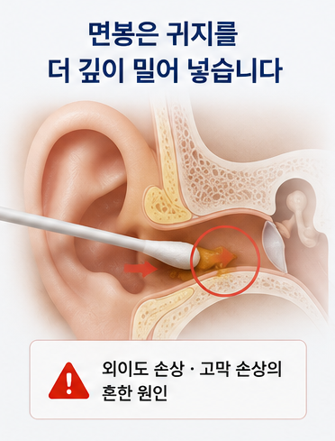 귀에 절대 넣으면 안 되는 것 4가지