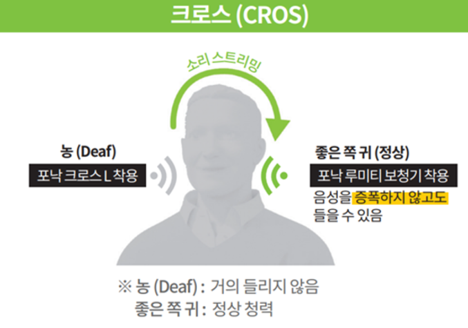 한쪽 귀만 안 들려도 보청기가 필요할까요? 편측성난청 크로스 보청기는 무엇일까요?