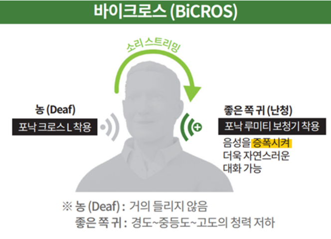 한쪽 귀만 안 들려도 보청기가 필요할까요? 편측성난청 크로스 보청기는 무엇일까요?