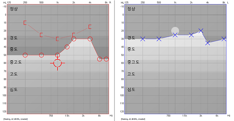 고막천공으로 인한 전음성난청, 보청기로 도움이 될 수 있을까요?