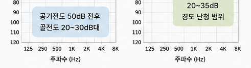 고막천공으로 인한 전음성난청, 보청기로 도움이 될 수 있을까요?