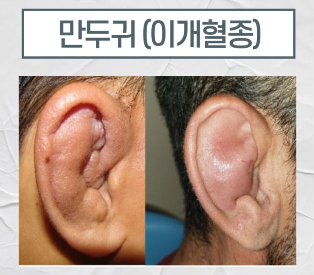 귀혈자리 누른다고 귀침,귀지압 괜찮을까? 귀 건강에도 좋을까?